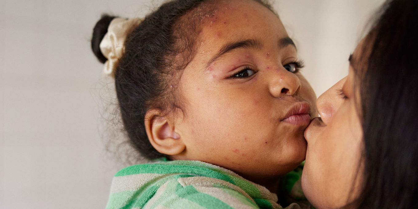 Flicka med vattkoppor i ansiktet blir buren av sin mamma. De gör pussmun till varandra.